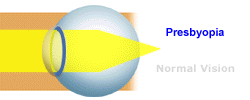 eyeball-presbyopia